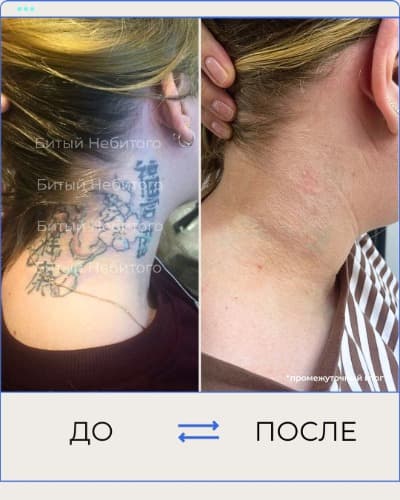 Удаление татуировки